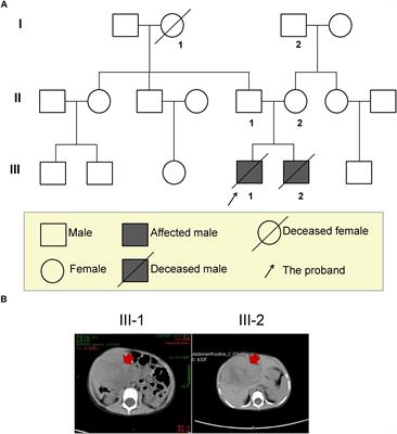 Whole-Genome Sequencing Identifies a Novel Variation of WAS Gene Coordinating With Heterozygous Germline Mutation of APC to Enhance Hepatoblastoma Oncogenesis